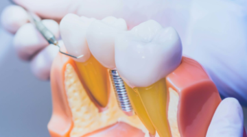 10 Dicas de Implantes Dentários
